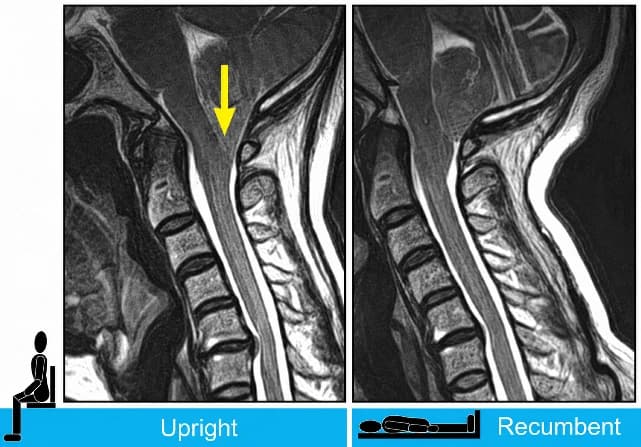 Upright MRI와 누운 자세 MRI 비교